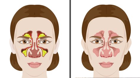 Getting a cold or allergy means dealing with some annoying symptoms such as being congested. Here are 5 simple ways to remove mucus and phlegm naturally.. Getting Rid Of Mucus, Remedy For Sinus Congestion, Mucus Relief, Getting Rid Of Phlegm, Home Remedies For Sinus, Sinus Congestion Relief, Best Cough Remedy, Natural Decongestant, Cold Or Allergies