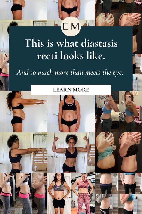 Diastis Recti Exercises, Diastasis Recti Repair, What Is Diastasis Recti, Muscle Separation, Flatten Belly, Healing Diastasis Recti, Diastasis Recti Exercises, Postpartum Health, Stomach Muscles