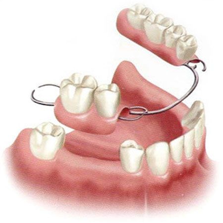 Partial Dentures, a Viable Alternative to Dental Implants? Denture Adhesive, Tooth Repair, Dental Implants Cost, Partial Dentures, Tooth Replacement, Perfect Teeth, Missing Teeth, Teeth Implants, Dental Bridge