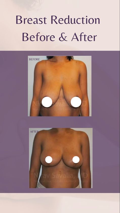 Click the link to see more of our transformstions! Breast Surgery Before And After, Breast Lift Before And After, Breast Lift Surgery Before And After, Breast Reduction Before And After, Baby Led Weaning Lunch Ideas, Mummy Makeover, 2025 Vison, Breast Lift Surgery, Breast Reduction Surgery