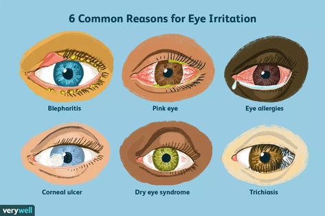 Eye Irritation Remedies, Eye Health Facts, Corneal Abrasion, Pinkeye Remedies, Eye Facts, Parts Of The Eye, Basic Anatomy And Physiology, Plant Lights, Drawing Eye