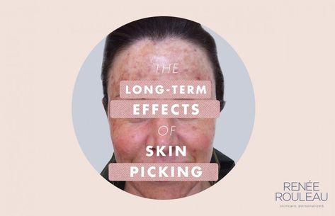 Picking At Your Skin Causes Damage And This Photo Proves It Stop Picking Face, Stop Skin Picking, How To Stop Picking Skin, How To Stop Skin Picking, How To Stop Picking Your Face, Stop Picking Skin, Picking At Skin, Stop Bad Habits, Picking Disorder