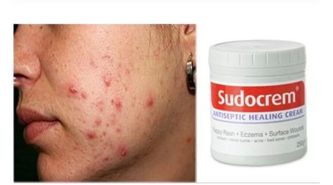 Sudocrem Acne, Rash Cream, How To Get Rid Of Acne, A God, Care Tips, Beauty Care, Some People, Clear Skin, Skin Care Tips