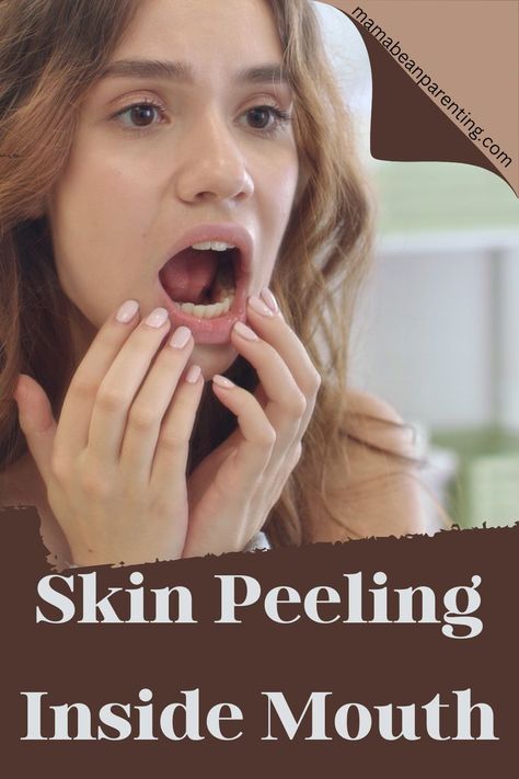 Skin peeling inside the mouth is not something uncommon. Most people experience it. If this is your first time that the skin is peeling inside the mouth or inside of the lips, I will try to help you find the cause of that. Lips Peeling, Peeling Skin, My Mouth, Family Life, First Time, The Skin, Lips, Skin