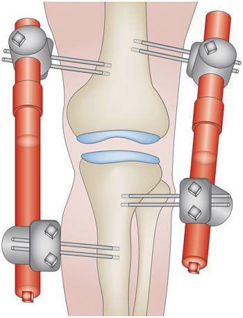 Alternative to Knee Replacement: Knee Joint Distraction – Howard J. Luks, MD Knee Pain Stretches, Knee Replacement Recovery, Knee Pain Relief Remedies, Knee Operation, Knee Pain Relief Exercises, Knee Strengthening Exercises, How To Strengthen Knees, Knee Pain Exercises, Knee Problem