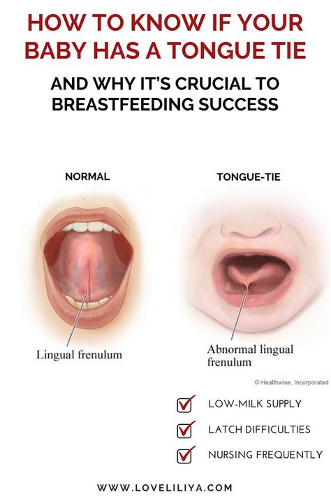 When a baby STRUGGLES to BREASTFEED, usually a TONGUE-TIE isn't the first thing that comes to mind. However, IT SHOULD!! Find out what a TONGUE-TIE is and how to DIAGNOSE it!! Failure To Thrive, Low Milk Supply, Tongue Health, Tongue Tie, Breastfed Baby, Babies Newborn, Lactation Consultant, Nursing Baby, Breastfeeding And Pumping