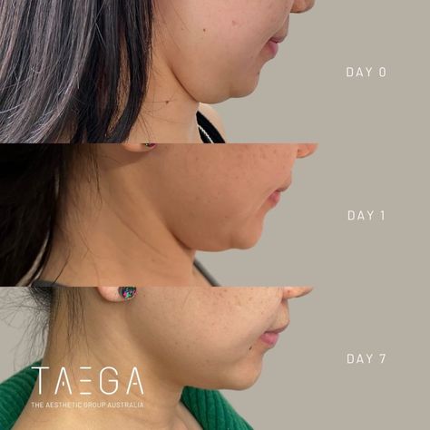 Lemon Bottle Fat Dissolving Solution - TAEGA Lemon Bottle Fat Dissolving, Botox Aesthetic, Fat Dissolving Injections, Chin Reduction, Beauty Redefined, Post Inflammatory Hyperpigmentation, Platelet Rich Plasma, Facial Tattoos, Botox Fillers