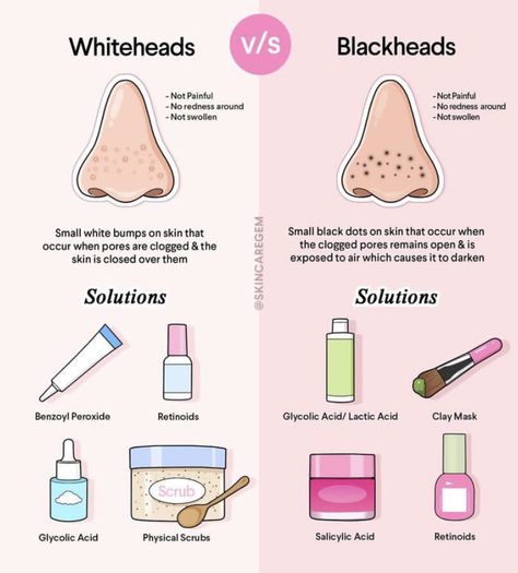 How to prevent black heads and whiteheads what are they what products to use to treat whitehead and black heads How To Clear Whiteheads On Nose, Things That Are Good For Your Skin, Black Head Skin Care, How To Get Rid Of Black Heads, How To Get Rid Of White Heads, Whiteheads Removal, Black Heads, Face Skin Care Routine, Skin Advice