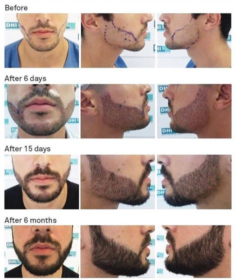 Beard Line, Beard Transplant, Hair Transplant Cost, Hair Transplant Procedure, Fashion Infographic, South Point, Best Hair Transplant, Perfect Beard, Aesthetic Clinic