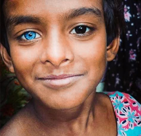 Caused by excessive or a lack of melanin, this condition is called heterochromia iridis and only around 6 out of every… by yacinestocker Heterochromia Eyes, Two Different Colored Eyes, Eye Colours, Change Your Eye Color, Different Colored Eyes, Skin Grafting, Amazing Eyes, Windows To The Soul, Most Beautiful Eyes