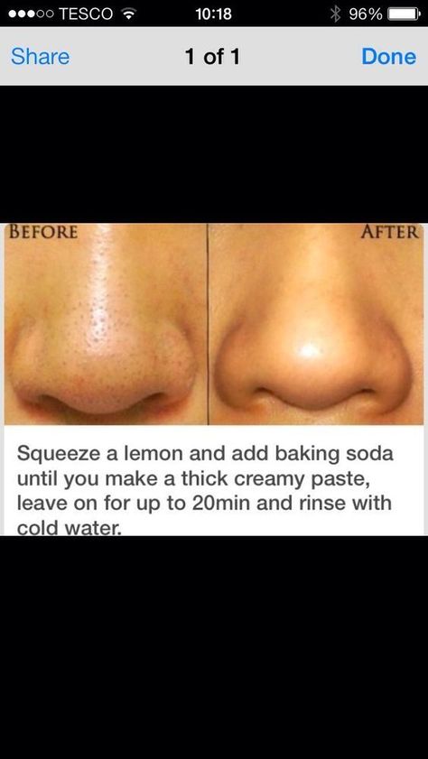 Get Rid Of Pores, Obličejové Masky, Skin Moles, Black Heads, Baking Soda Shampoo, Get Rid Of Blackheads, Skin Pores, Beauty Tricks, Clogged Pores