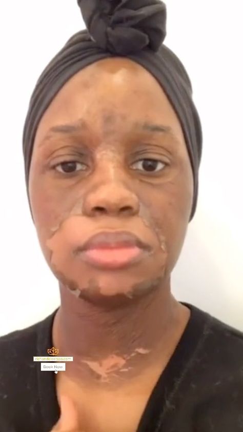 richandclear on Instagram: Chemical peels are a great solution for a range of skin concerns, from wrinkles to acne to hyper-pigmentation. 😌🤍 Our Annual Mothers Day… Chemical Peel Before And After Black, Clear Skincare, Ethnic Rhinoplasty, Hyper Pigmentation, Chemical Peels, Celebrity Plastic Surgery, North Miami Beach, Peeling Skin, Chemical Peel