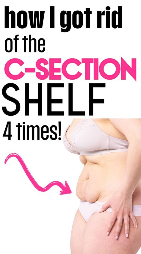 A new mom trying to lose her c-section shelf postpartum tummy with these postpartum workout tips. Shelf Workout, C Section Pouch, Postpartum Belly Workout, C Section Belly, After C Section Workout, C Section Workout, Post C Section, Postpartum Tummy, Belly Workouts