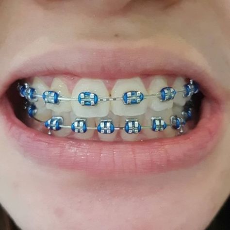 Dental Braces Colors, Braces Colors Combinations, Invisible Teeth Braces, Natural Teeth Whitening Diy, Braces Bands, Cute Braces Colors, Braces Cost, Adult Braces, Braces Tips