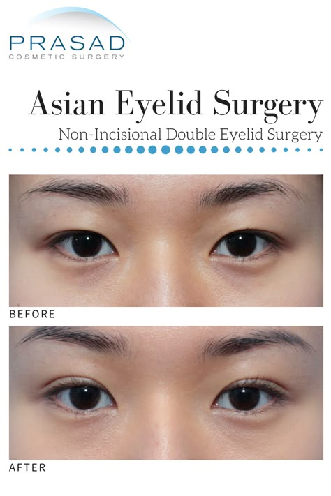 Before and After: Asian Double Eyelid Surgery (Non-Incisional)  #asianeyelidsurgery #doubleeyelidsurgery #asianeyelids #doubleeyelids #eyelidsurgery #cosmeticsurgery Tapered Eyelids Aesthetic, Double Eyelid Surgeries, Plastic Surgery Double Eyelid, Double Eyelids Korean, Eyelid Lift Surgery Before After, Korean Double Eyelid, Eyelid Surgeries, Asian Double Eyelid, Eyes Surgery