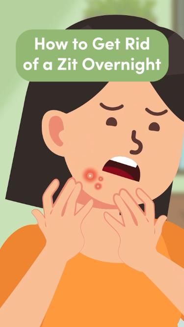 How to Get Rid of a Zit Overnight How To Get Rid Of A Zit Overnight, How To Get Rid Of Pustules, How To Get Rid Of Pimples Overnight Diy, Skin Care Routine For Pimples, How To Get Rid Of Spots Overnight, How To Get Rid Of Whiteheads, How To Get Rid Of Closed Comedones, How To Get Rid Of Pimples Overnight, Underground Pimple