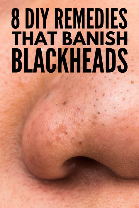 The Best Way to Remove Blackheads: 8 At Home Blackhead Removal Ideas! Hydrogen Peroxide Skin, Blackheads On Cheeks, Remove Blackheads From Nose, Blackhead Remover Diy, Blackhead Remedies, To Remove Blackheads, Blackheads On Nose, Rid Of Blackheads, Remove Blackheads