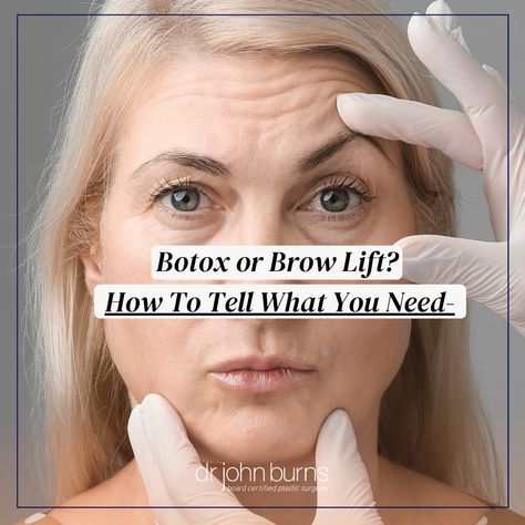 Aging caucasian woman being evaluated by a person in medical gloves while raising her eyebrows Eyebrow Arch Shape, Endoscopic Brow Lift, Brow Lift Surgery, Botox Forehead, Uneven Eyebrows, Botox Brow Lift, Forehead Lift, Facial Aging, Types Of Eyebrows