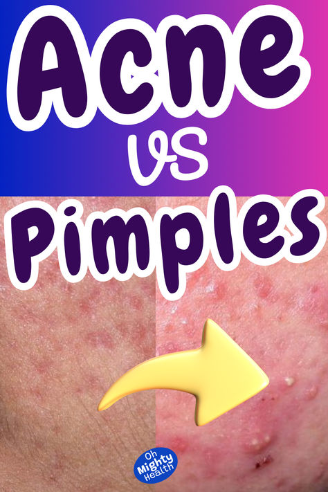 Close-up of skin showing different types of acne and pimples with varying degrees of inflammation and redness. Pimples And Their Meaning, What Pimples On Your Face Mean, Causes Of Pimples, Pustules Acne, Acne Types, Types Of Pimples And How To Treat Them, Clear Pimples, Nodule Acne, Redness Pimple