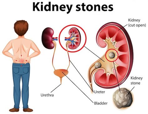 lemon and kidney stones Stone Aesthetic, Pregnancy Supplements, Brain Health Supplements, Heart Hospital, Medical Brochure, Creatinine Levels, Medical Astrology, Kidney Stone, Healthy Kidneys