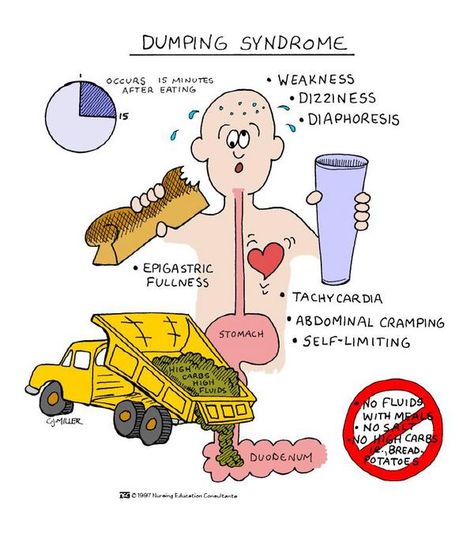 Possible post op complication for Gastroduodenostomy (Billroth I) or Gastrojejunostomy (Billroth II).. The minute they complain of cramps, listen for borborygmus sounds. the pt will have the urge to defecate, they'll be sweating, have dizziness and palpitations. Nursing Terminology, Gi Nursing, Counselling Tips, Dumping Syndrome, Nursing School Life, Nursing Study Tips, Young And, Nclex Review, Med Surg Nursing