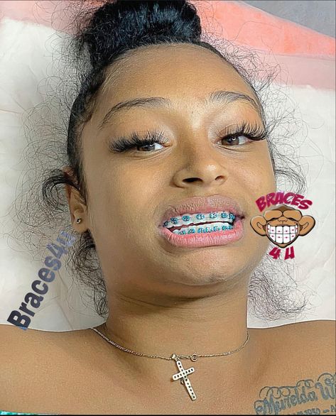 Bright Braces Colors, Teal Braces On Black People, Turquoise Braces, Lilac Braces, Teal Braces, Dark Blue Braces, Brace Ideas, Power Chain Braces, Dental Braces Colors