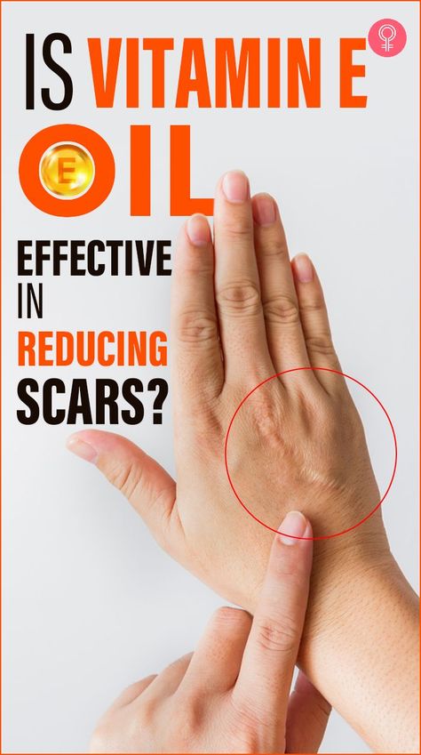 scar on a hand. vitamin E oil for scars on body. Benefits Of Vitamin E, Oils For Scars, Oil Skin, Large Pores, Oil Benefits, Oil Uses, Vitamin E Oil, Be Safe, Diy Face Mask