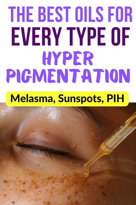 Woman being treated for hyperpigmentation with oil. Text reads: The best oils for every type of hyperpigmentation. Melasma, sunspots, PIH. Scientifically proven. Clearing Dark Spots, Glass Skin Home Remedies, Tomato Skin Care, Skincare Hyperpigmentation, Pigmentation Remedy, Hyperpigmentation Remedies, Removing Hyperpigmentation, At Home Skincare, Skincare At Home