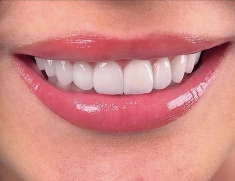 Teeth Aesthetic, Pretty Teeth, Haut Routine, Beautiful Teeth, Straight Teeth, Perfect Teeth, Vision Board Images, Vision Board Photos, Teeth Health