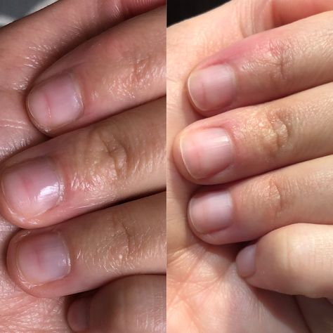 My Recovery From Nail Damage — ThePolishedPA Nail Bed Damage, Soft Glam Wedding Makeup Brides, Short Nail Bed, Toe Nail Fungal Infection, Soft Glam Wedding Makeup, Soft Glam Wedding, Nail Discoloration, Nails After Acrylics, Jewel Hair