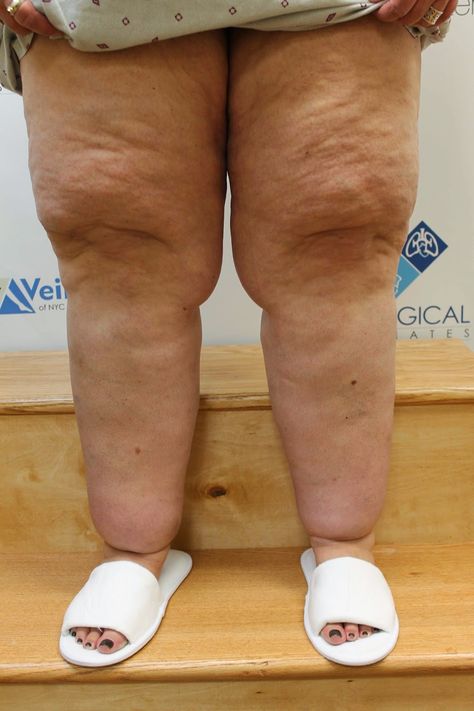 The Well-Rounded Mama: Lipedema, Part 4: Possible Causes and Associated Conditions Lipedema Diet, Lymph Fluid, Lymph Massage, Knee Pain Relief, Nutritional Deficiencies, Leg Pain, Calorie Intake, Health Info, Massage Therapy