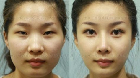 South Korean Plastic Surgeons Are Too Good At Their Job South Korean Plastic Surgery, Eyes Surgery, Korean Plastic Surgery, Bigger Eyes, Beauty Hacks Skincare, Before And After Pics, Double Eyelid, Passport Photo, Reconstructive Surgery