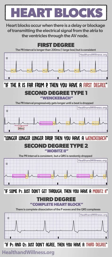 Heart Blocks EKG Rhythm Infographic Ekg Rhythms, Nurse Teaching, Paramedic School, Nursing School Essential, Nurse Study Notes, Nursing Mnemonics, Nursing Student Tips, Cardiac Nursing, Heart Blocks