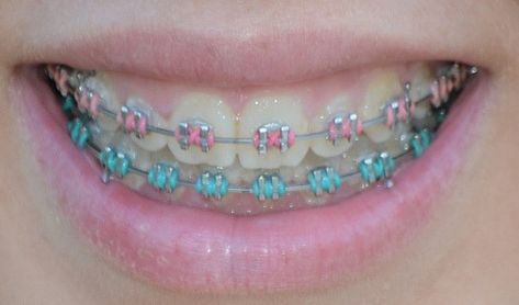 Natural Teeth Whitening Diy, Cute Braces Colors, Kids Braces, Braces Tips, Getting Braces, Cute Braces, Teeth Whitening Diy, Braces Colors, Dental Braces