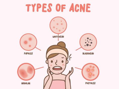 Nodule Acne, Pustules Acne, Core Workout Gym, Exercise Belly, Workout Stomach, Different Types Of Acne, Good Arm Workouts, Lose Stomach Fat Fast, Exercise Board