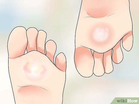 Image titled Know if You Have Athlete's Foot Step 4 Purification Essential Oil, Tinea Pedis, Yeast Infection Symptoms, Heath Tips, Diy Lotion, She Walks In Beauty, Eating Good, Athletes Foot, Foot Soak