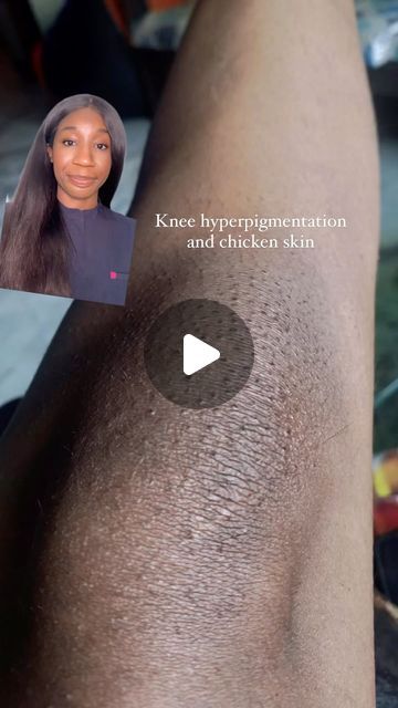 Dark Knees Remedy Fast, Smooth Knees, Glycolic Acid Before And After, Smooth Body Skin, Body Retinol, Glowing Body Skin, Dark Knees, Pimple Cream, Regular Skin Care Routine