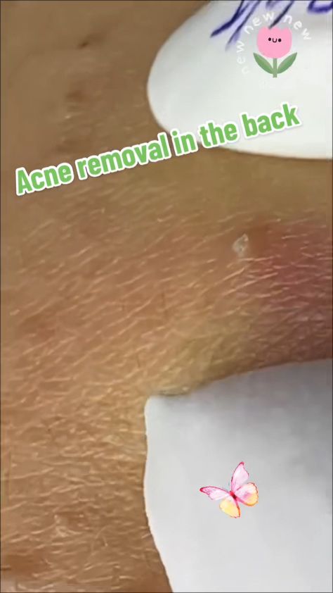 Comprehensive guide to banishing blackheads and achieving a radiant complexion. #UltimateGuide #BlackheadRemoval #RadiantSkin Please Re-Pin for later 😍💞 Learn More with a Click! 📌 silicone patches for stretch marks reddit, blackheads back youtube, blackheads whiteheads removal peel off mask 😘 #glowingskin #drugstorecosmetics #puffiness Huge Blackheads Popping, Blackhead Popping, Neck Pimples, Huge Blackheads, Laser Stretch Mark Removal, Whiteheads Removal, Pimples On Scalp, Pore Extraction, Best Peel Off Mask