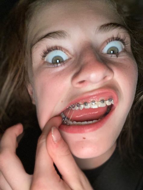 Putting on rubber bands Teeth Goals, Braces On Teeth, Girl With Braces, Braces Ideas, Braces Rubber Bands, High School Senior Year, Mouth Hygiene, Headshot Photoshoot, Girls With Braces