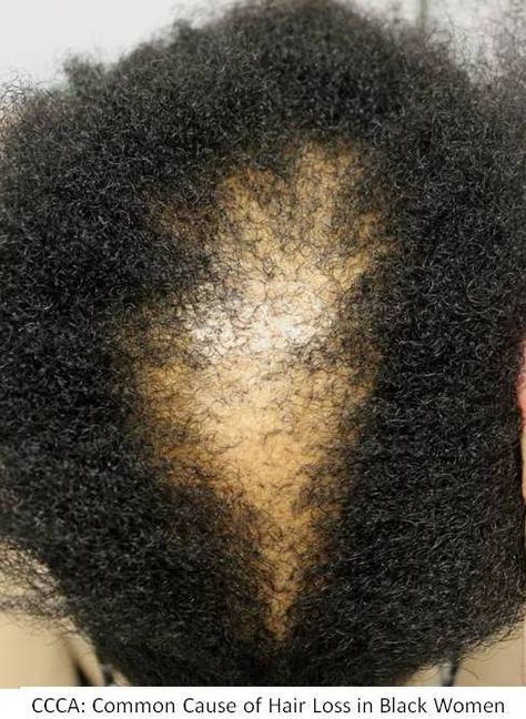 Thinning Hair Black Women, Narrow Laundry Room Ideas, Alopecia Hair Growth, Thinning Hairline, Narrow Laundry, Narrow Laundry Room, Alopecia Hairstyles, Androgenic Alopecia, Hair Black Women