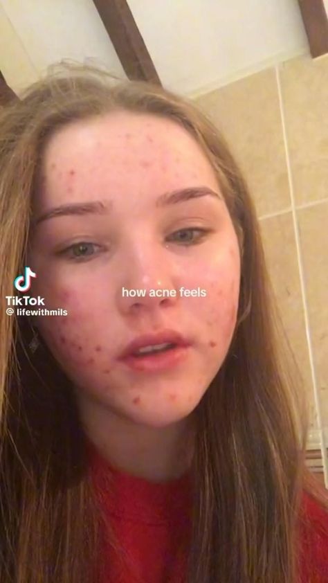 How acne feels Acne Face Map, Acne Prone Skin Care Routine, Acne Positivity, Face Map, Ariana Grande Victorious, Face Mapping Acne, Acne Prone Skin Care, Bad Acne, Good Skincare