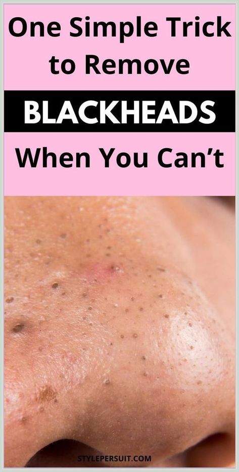 Get Rid of Blackheads For Good Remove Blackheads From Nose, Blind Pimple, Blackhead Remedies, Blackheads On Nose, Rid Of Blackheads, Black Heads, Blackhead Mask, Blackheads Removal, Cold Sores Remedies