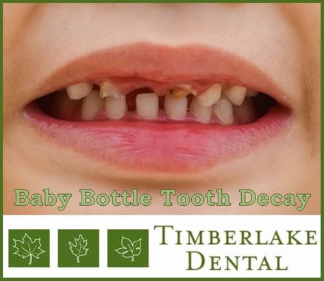 What is Baby Bottle Tooth Decay, and how does it happen?  Read this week's blog for answer.  https://www.timberlakedental.com/blog/2018/baby-bottle-tooth-decay-2/ Wisdom Teeth Quotes, Dental Office Organization, Wisdom Teeth Funny, Baby Bottle Tooth Decay, Dental Surgery Food, Teeth Illustration, Dentist Day, Black Teeth, Teeth Whitening Products