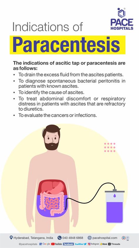 Paracentesis  indications Nurse Tips, New Grad Nurse, Abdominal Discomfort, Best Hospitals, Nursing Notes, Respiratory, Cavities, Hyderabad, Twitter Instagram