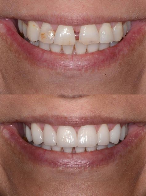 Don't like the space between your front teeth?   Dr. Hulse can fix that with several different methods. Smile Tips, Dental Ceramics, Space Between Teeth, Dental Business Cards, Dental Posters, Unwanted Hair Growth, Dental Fun, Medical Animation, Loose Tooth