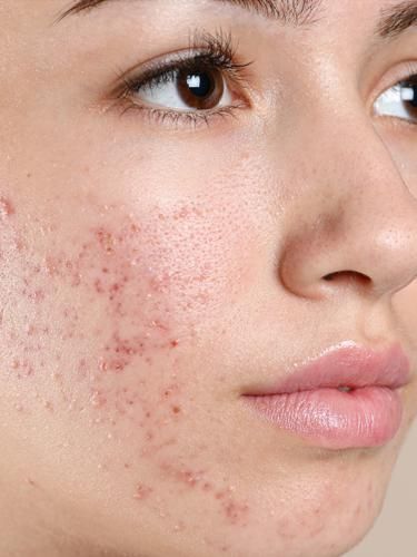 different types of acne
scar treatment
best acne treatment
types of acne
acne positivity
scar removal
acne map
hyperpigmentation
hyperpigmentation black skin
dark spots remedies
dark spots
clear glowing skin
clear skin Acne Images, Acne Aesthetic, Acne Positivity, Facial Peels, Acne Scar Diy, Blind Pimple, Pimples Under The Skin, Acne Overnight, Pimples Overnight