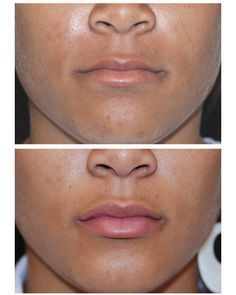 Voluma Cheeks, Lip Fillers Juvederm, Juvederm Lips, Botox Before And After, Face Fillers, Botox Lips, Botox Cosmetic, Cheek Fillers, Natural Breast Enlargement