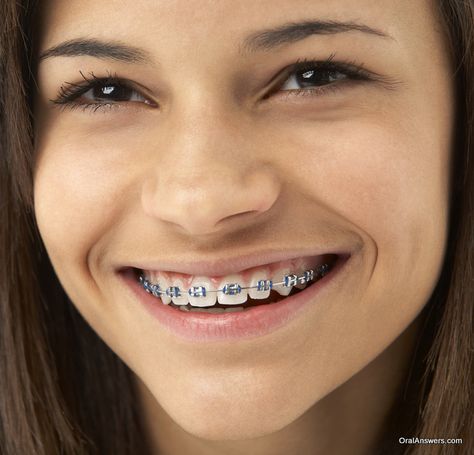 Teeth After Braces, Blue Braces, After Braces, Fix Teeth, Getting Braces, Braces Girls, Braces Colors, Charcoal Teeth Whitening, Dental Braces