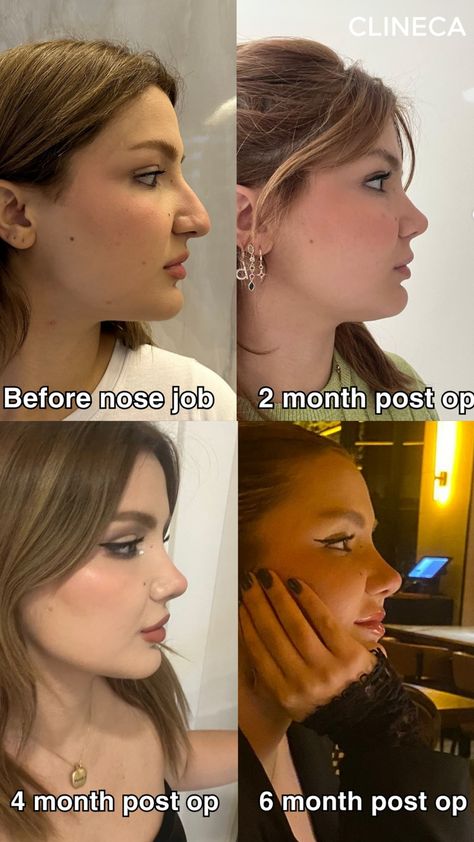 ✨ Dream Nose Unveiled! ✨  Another stunning nose job transformation at Clineca! 👃💫 Witness the beauty of precision and artistry as our patient embraces their confident new look. Ready for your turn? 🌿💖 #nosejob #glowup #nasenop #rhinoplasty #plasticsurgery #sideprofile Nose Tip Surgery Before After, Rhinoplasty Before After, Nose Job Before And After, Liquid Rhinoplasty, 6 Month Transformation, Upturned Nose, Dream Nose, Rhinoplasty Nose Jobs, Rhinoplasty Before And After