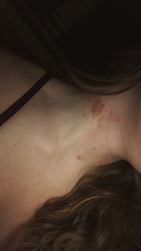 #hickey #hickeys #neck #lovebites Strangled Neck Aesthetic, Initial With Hickey, Lovebites Mark Aesthetic, Hicks On Neck Girl, How To Make Fake Hickies Neck, Hicks On Neck Aesthetic, Hickey On Dark Skin Tone, Hickies Neck Snapchat, Hickey Aesthetique Dark Skin